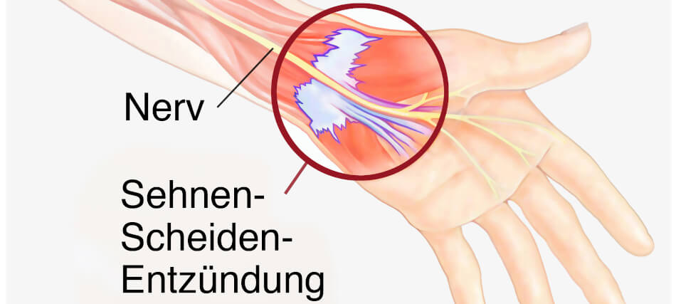 Die Diagnose der Sehnenscheidenentzündung lässt sich meist im Laufe eines Anamnesegespräches und einer klinischen Untersuchung feststellen