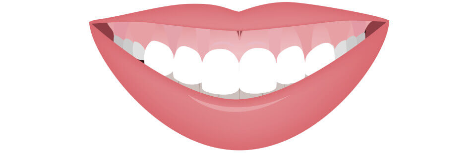 Gummy Smile vor der Behandlung