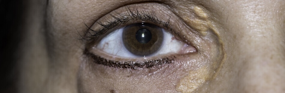 Xanthome können sich am gesamten Körper befinden während Xanthelasmen meist um die Augen herum auftritt
