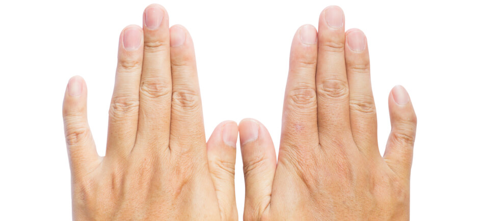 Die Klinodaktylie macht sich durch gekrümmte Finger bemerkbar