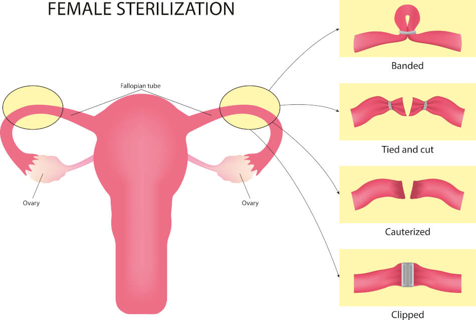 Es gibt viele unterschiedliche Methoden, wie der Arzt eine Sterilisation durchführen kann