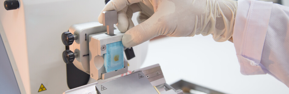 Die entnommene Gewebeprobe einer Biopsie wird in ein Labor zur Analyse geschickt.