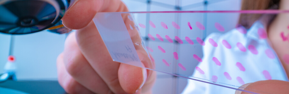 Die Probe einer Biopsie gibt Ausschluss über etwaige Krankheiten.