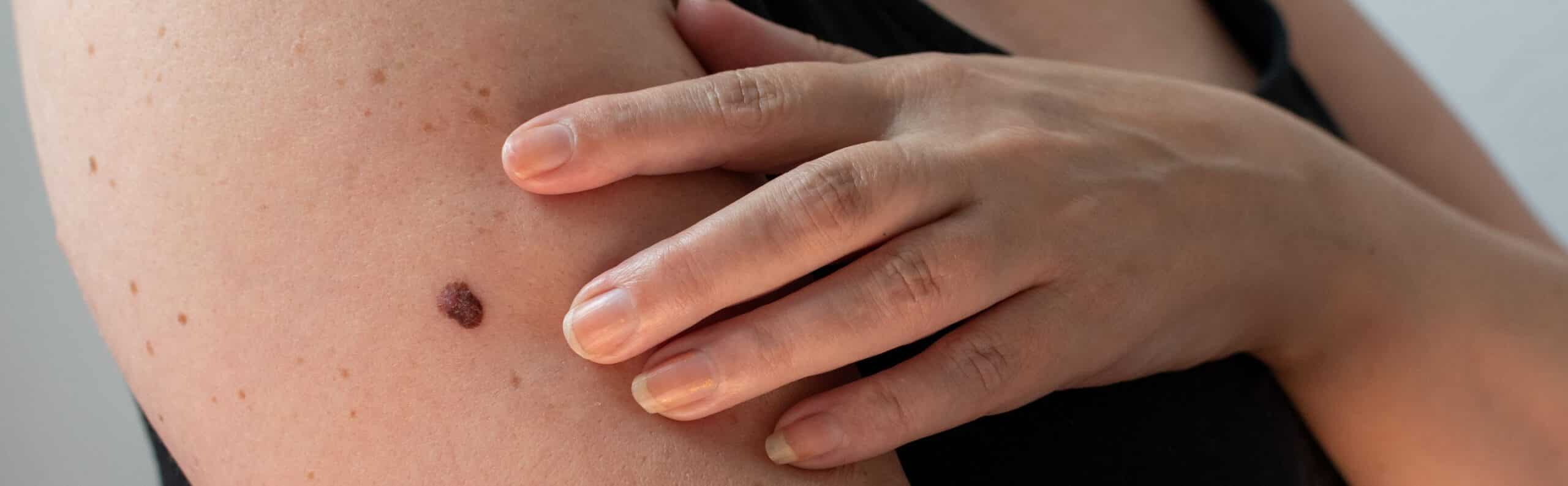 Melanom